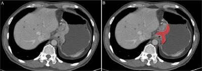 The Value of Predicting Human Epidermal Growth Factor Receptor 2 Status in Adenocarcinoma of the Esophagogastric Junction on CT-Based Radiomics Nomogram